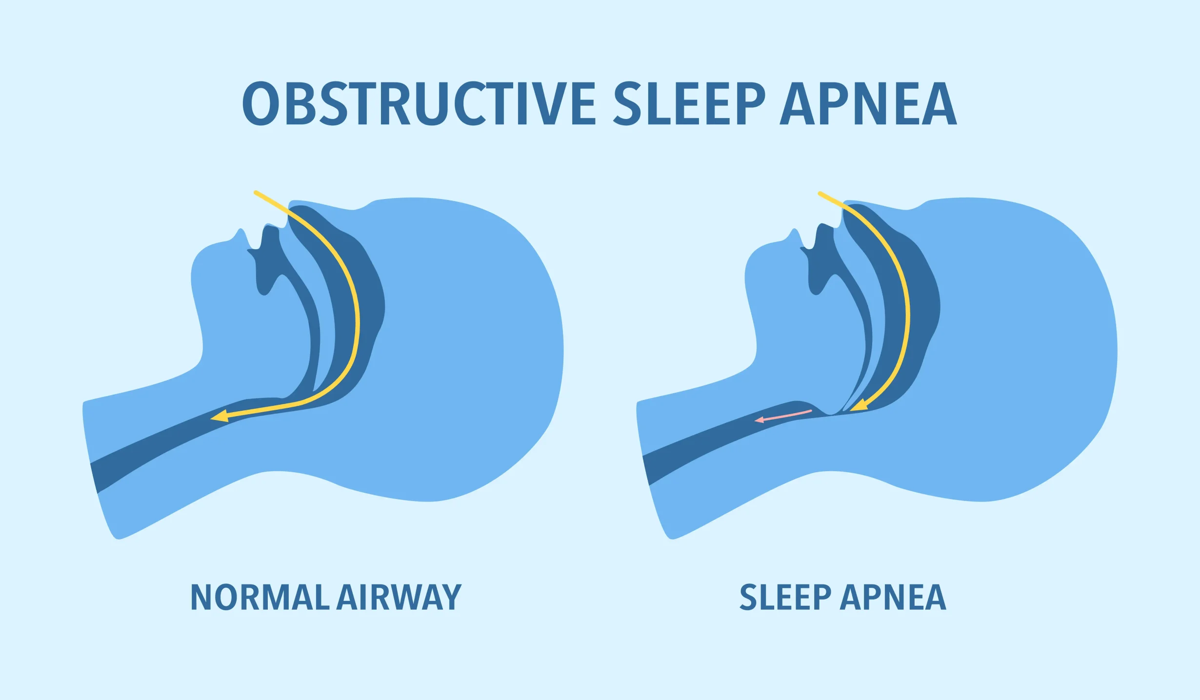 Airway comparison diagram